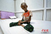 18岁女孩营养不良状如骷髅（图）世界卫生组织：霍乱所致