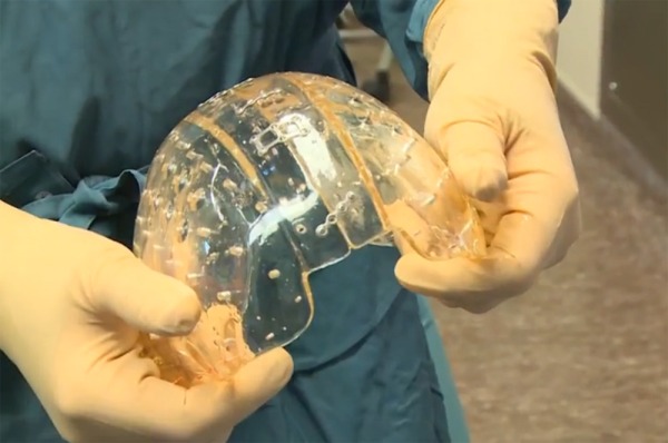 江苏狭颅症患儿在上海成功实施3D列印颅骨整