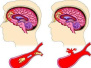 老年神经系统疾病的照护：脑卒中的概念